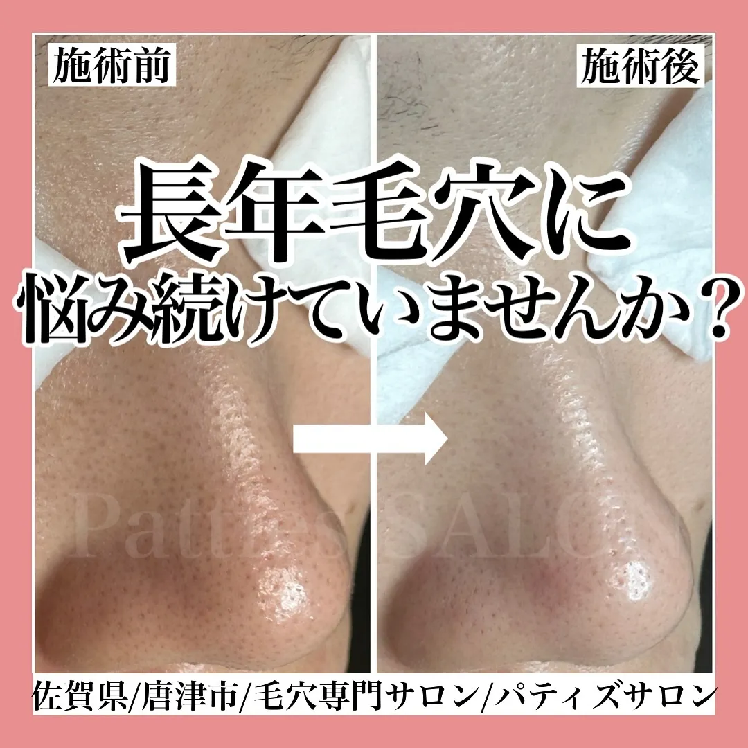 長年その毛穴に悩み続けていませんか？？