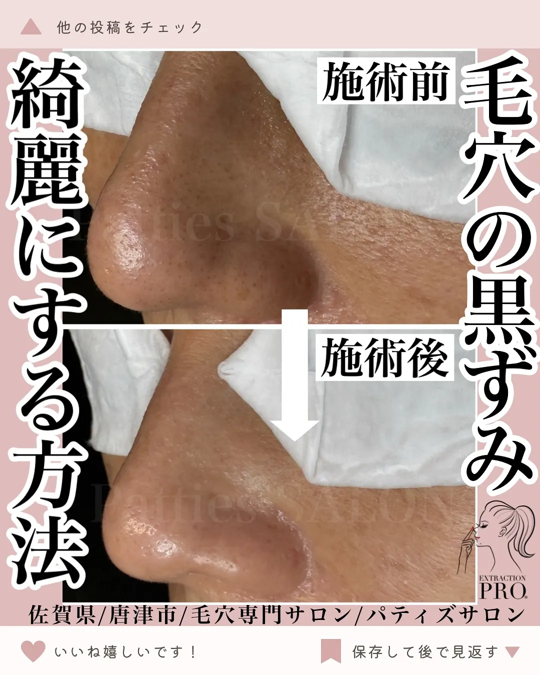 私がずっと毛穴に悩んでいたからこそ、この毛穴プロの技術を導入...