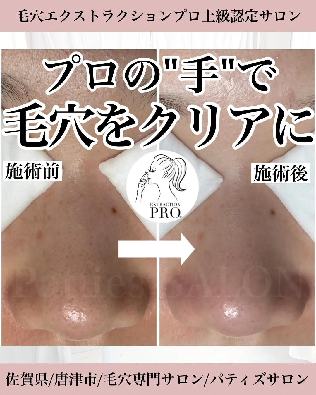 自己流では解決できない長年の黒ずみ・ザラつき…