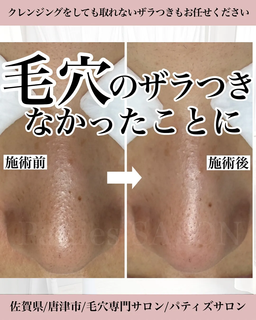 毛穴のざらつき、なかったことにできます!