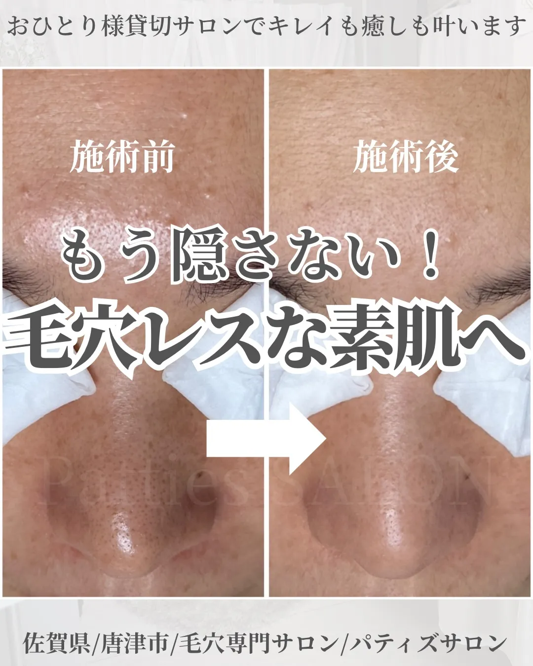 毛穴の悩み、もう終わりにしませんか?
