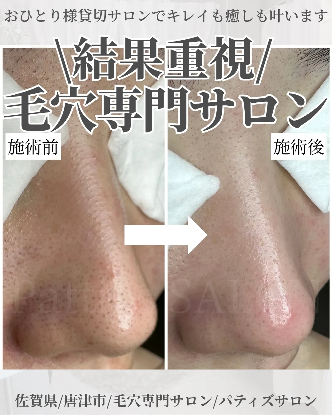 肌悩みNo.１の毛穴のお悩みでご来店いただいた