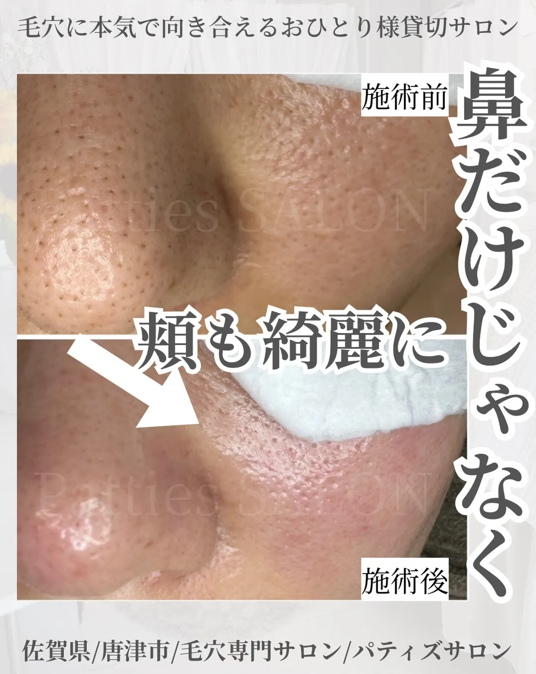 鼻だけ綺麗になるの？と思われる方もいらっしゃいますが