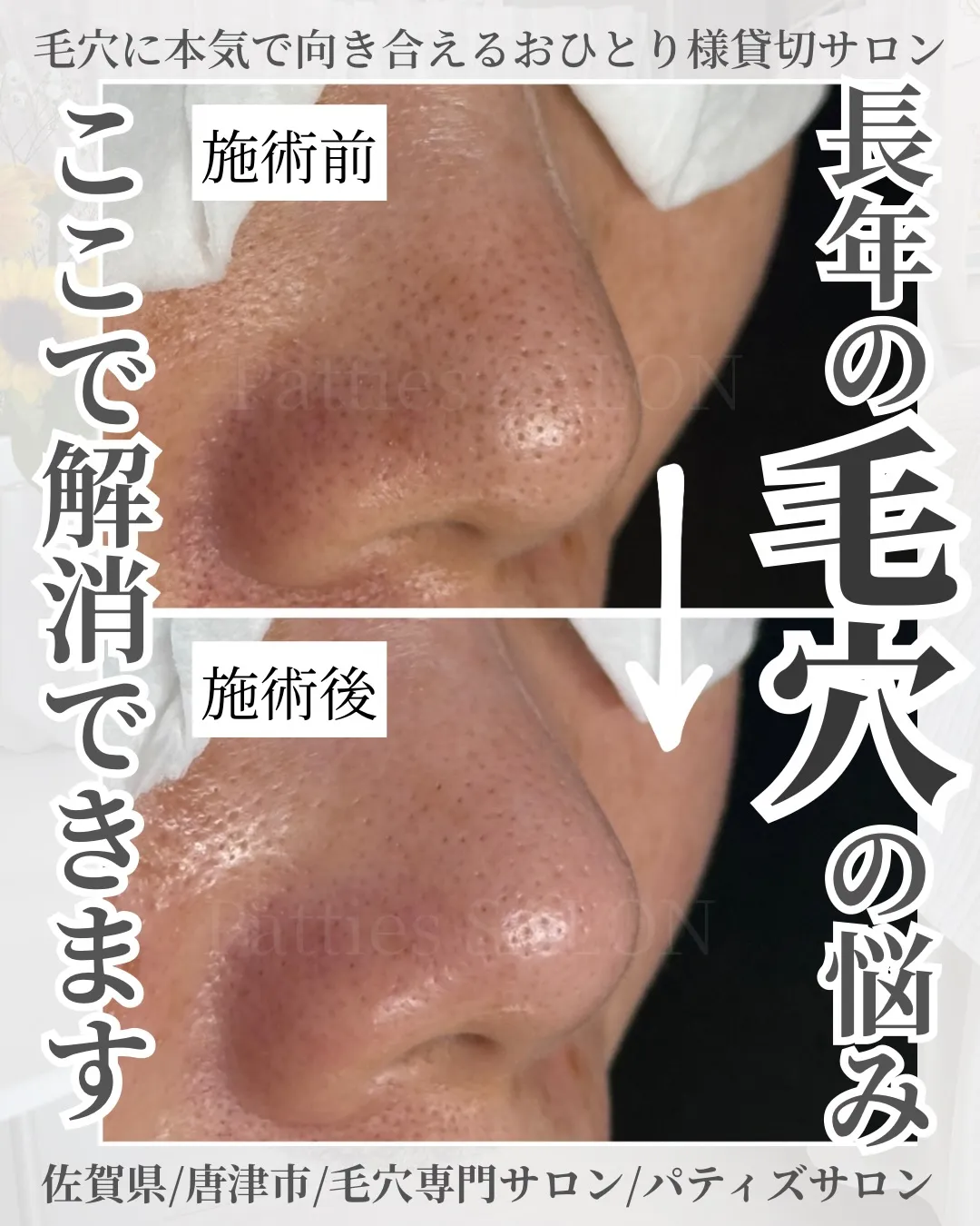 長年の毛穴の悩み、解消しませんか??